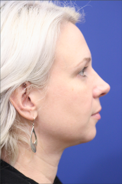 Liposuction after at Dr. Richard W. Maack, MD, FACS: Synergi Facial Surgery in Chesterfield, MO
