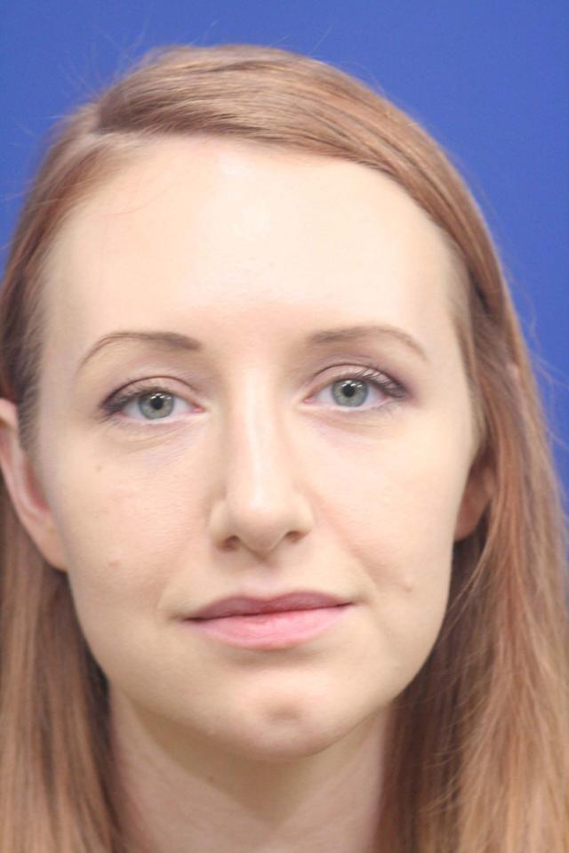 Ethnic Rhinoplasty after at Dr. Richard W. Maack, MD, FACS: Synergi Facial Surgery in Chesterfield, MO