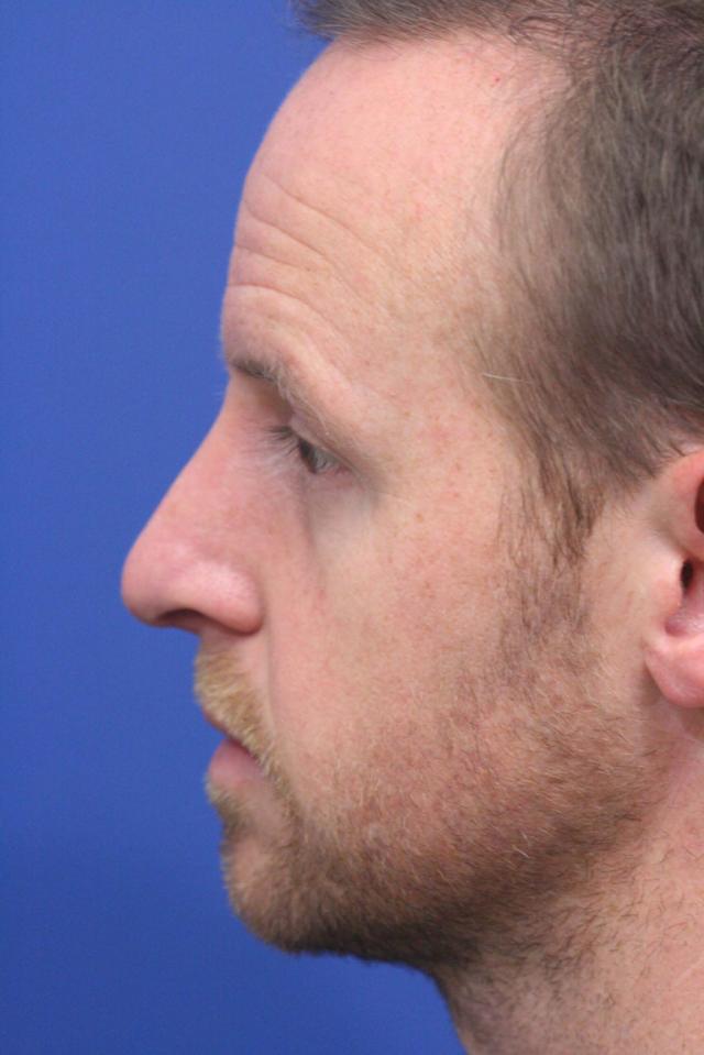 Ethnic Rhinoplasty after at Dr. Richard W. Maack, MD, FACS: Synergi Facial Surgery in Chesterfield, MO