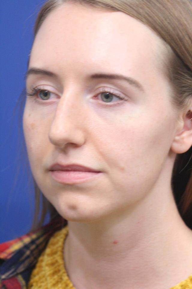 Ethnic Rhinoplasty before at Dr. Richard W. Maack, MD, FACS: Synergi Facial Surgery in Chesterfield, MO