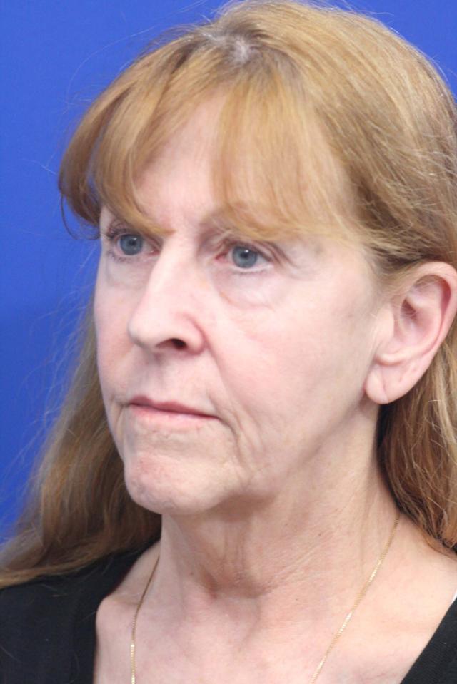 Mini Facelift before at Dr. Richard W. Maack, MD, FACS: Synergi Facial Surgery in Chesterfield, MO