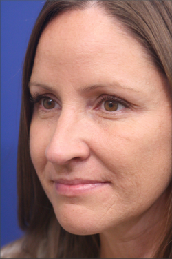 Dr. Richard W. Maack, MD, FACS: Synergi Facial Surgery rhinoplasty after — Chesterfield, MO
