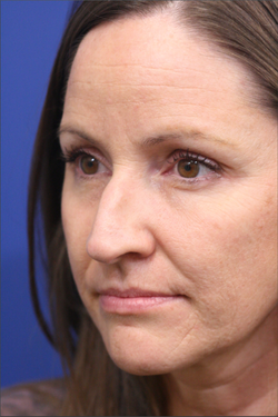 Ethnic Rhinoplasty before at Dr. Richard W. Maack, MD, FACS: Synergi Facial Surgery in Chesterfield, MO