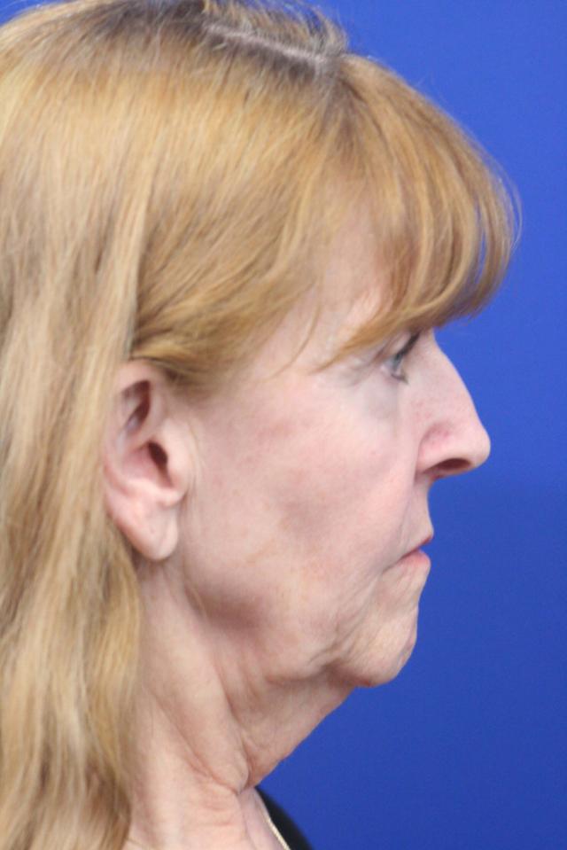 Mini Facelift before at Dr. Richard W. Maack, MD, FACS: Synergi Facial Surgery in Chesterfield, MO