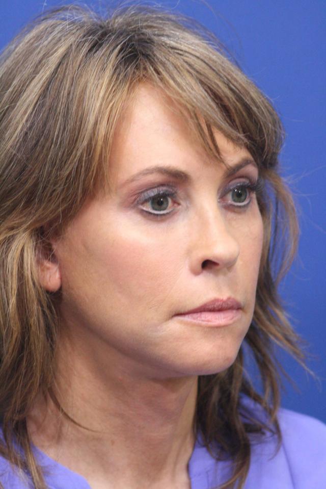 Mini Facelift after at Dr. Richard W. Maack, MD, FACS: Synergi Facial Surgery in Chesterfield, MO
