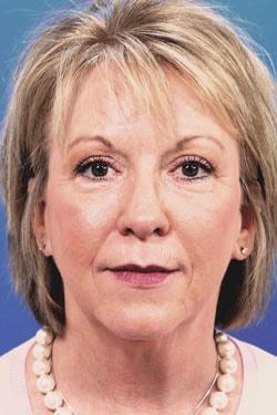 Blepharoplasty after at Dr. Richard W. Maack, MD, FACS: Synergi Facial Surgery in Chesterfield, MO