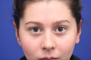 Dr. Richard W. Maack, MD, FACS: Synergi Facial Surgery otoplasty after — Chesterfield, MO