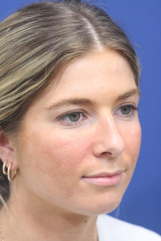 Ethnic Rhinoplasty before at Dr. Richard W. Maack, MD, FACS: Synergi Facial Surgery in Chesterfield, MO