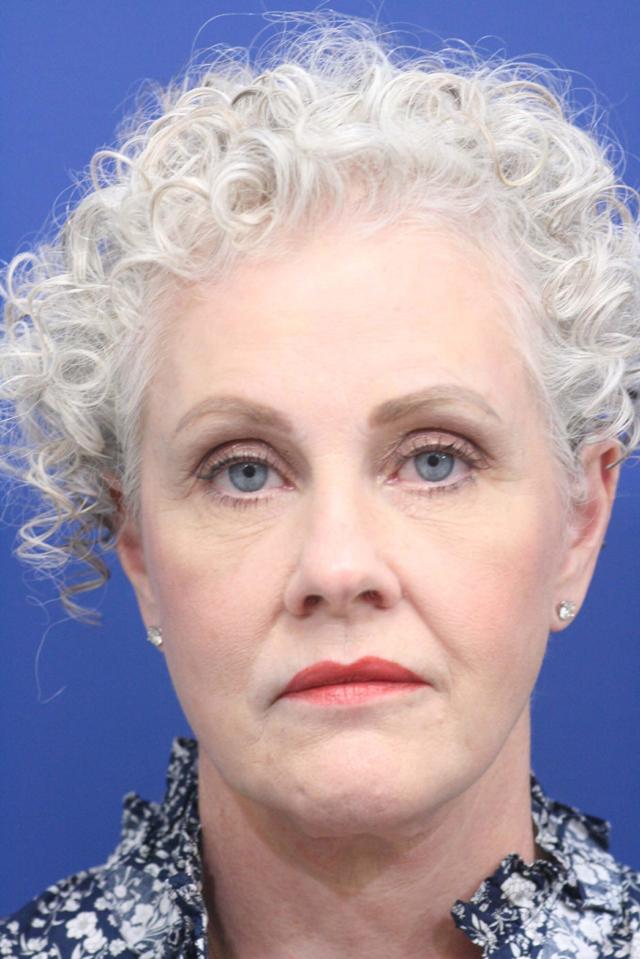 Brow Lift after at Dr. Richard W. Maack, MD, FACS: Synergi Facial Surgery in Chesterfield, MO