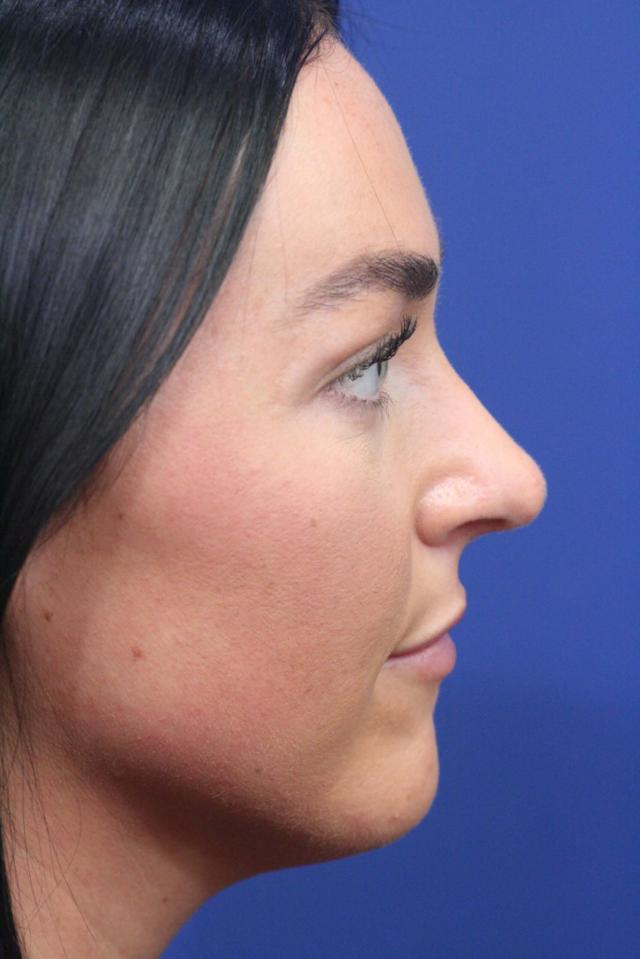 Ethnic Rhinoplasty after at Dr. Richard W. Maack, MD, FACS: Synergi Facial Surgery in Chesterfield, MO
