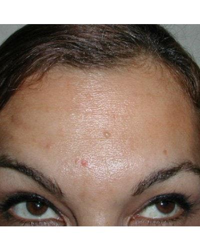 Gary S. Berger, MD, FACS botox after — New York, NY
