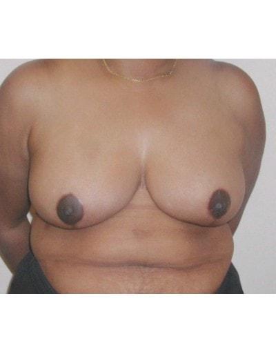 Gary S. Berger, MD, FACS breast reduction after — New York, NY