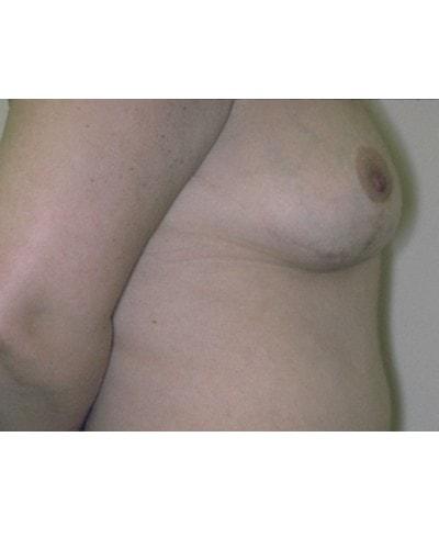 Gary S. Berger, MD, FACS breast lift after — New York, NY