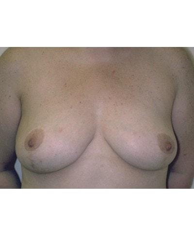 Gary S. Berger, MD, FACS breast lift after — New York, NY
