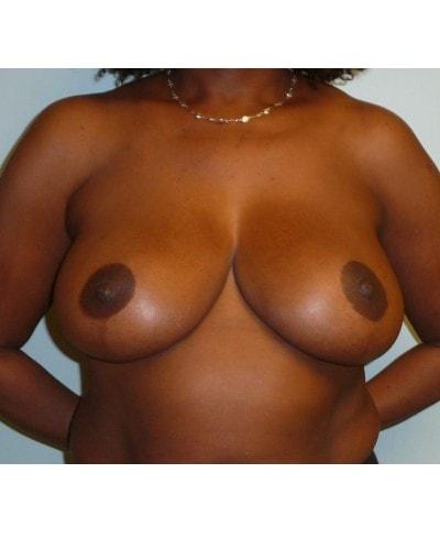 Gary S. Berger, MD, FACS breast reduction after — New York, NY