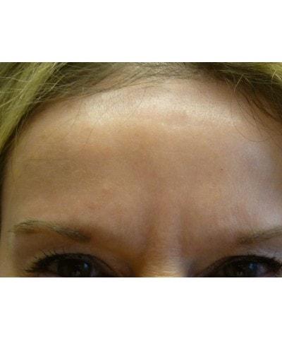 Gary S. Berger, MD, FACS botox after — New York, NY