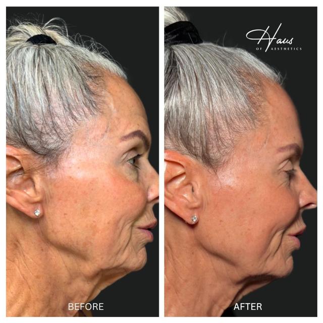 Laser Skin Resurfacing result at Haus of Aesthetics in Salt Lake City, UT