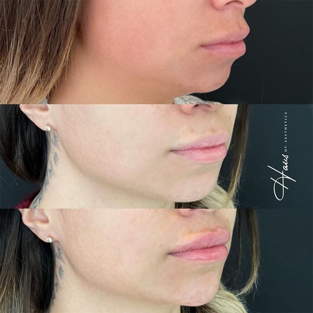 Jawline Filler result at Haus of Aesthetics in Salt Lake City, UT