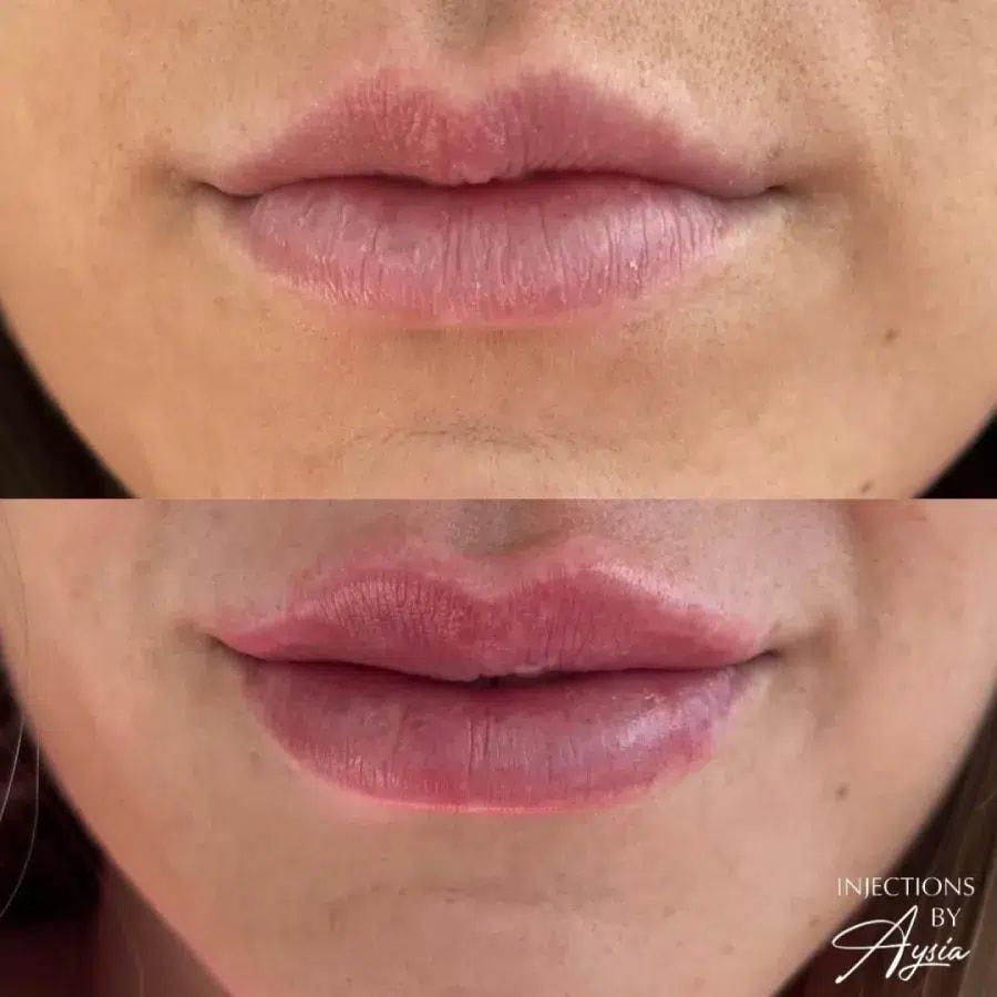Haus of Aesthetics lip filler result — Salt Lake City, UT