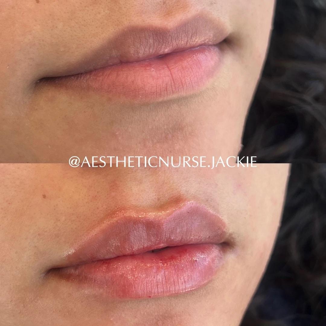 Haus of Aesthetics lip filler result — Salt Lake City, UT