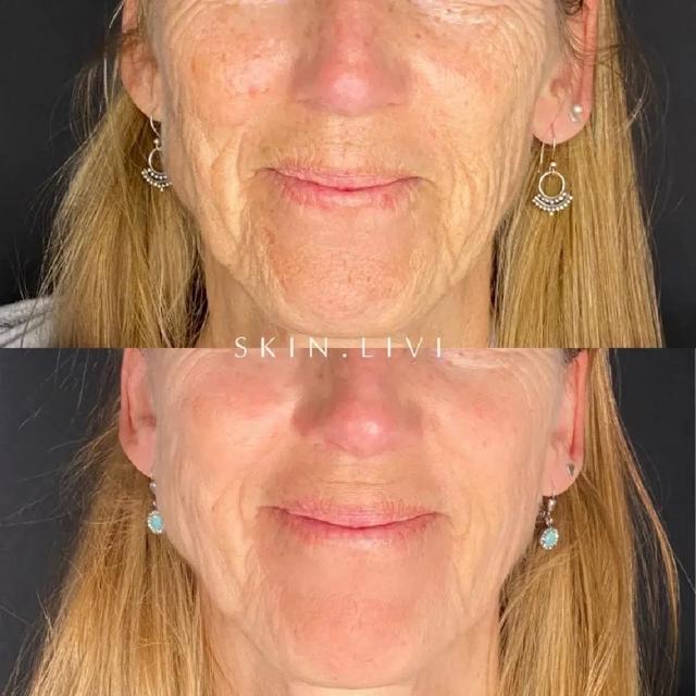 Microneedling result at Haus of Aesthetics in Salt Lake City, UT