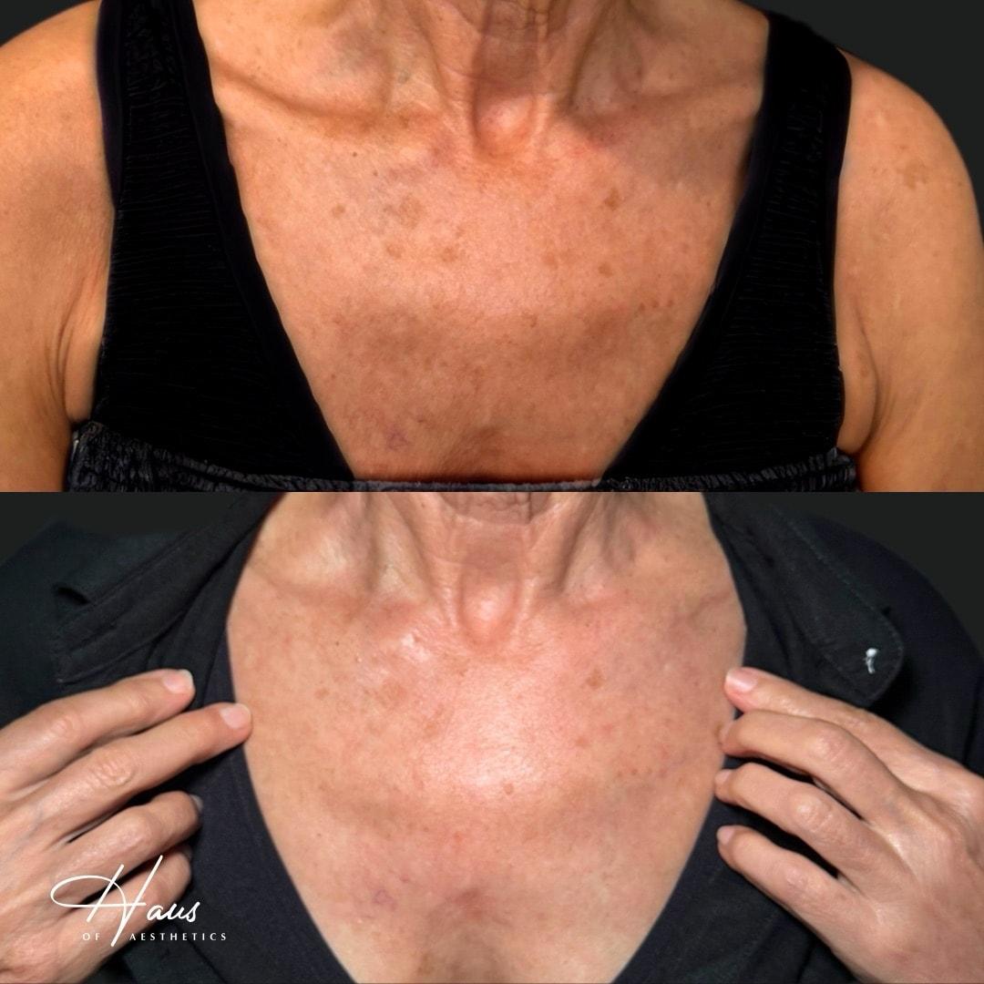 Haus of Aesthetics laser treatment result — Salt Lake City, UT