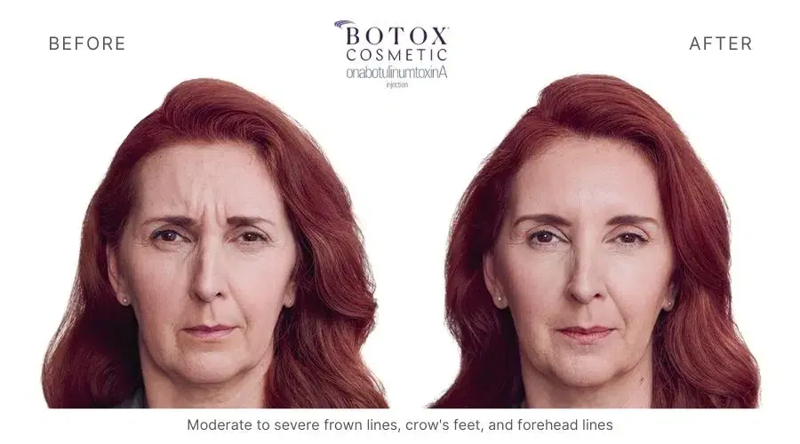 Haus of Aesthetics botox result — Salt Lake City, UT