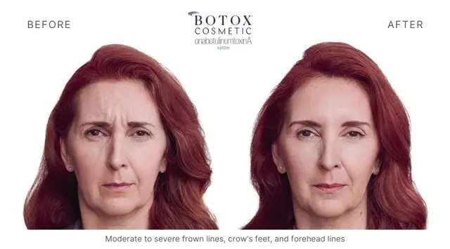 Botox result at Haus of Aesthetics in Salt Lake City, UT