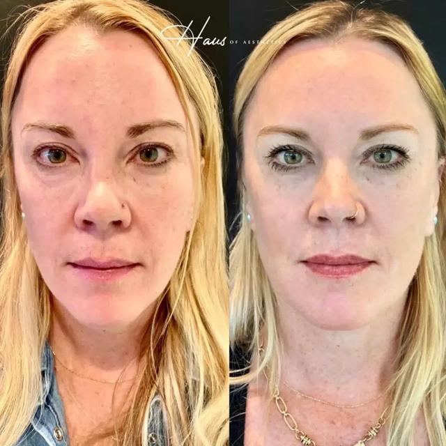 Juvederm result at Haus of Aesthetics in Salt Lake City, UT