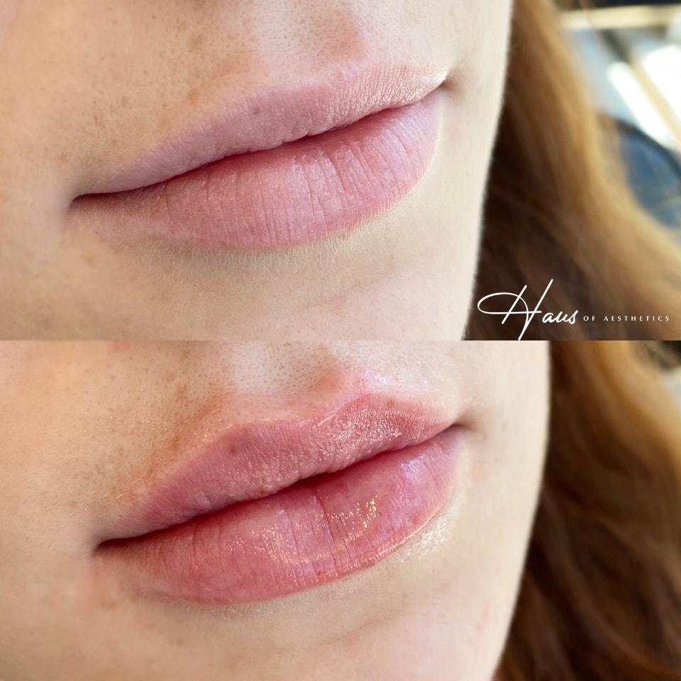 Haus of Aesthetics lip filler result — Salt Lake City, UT