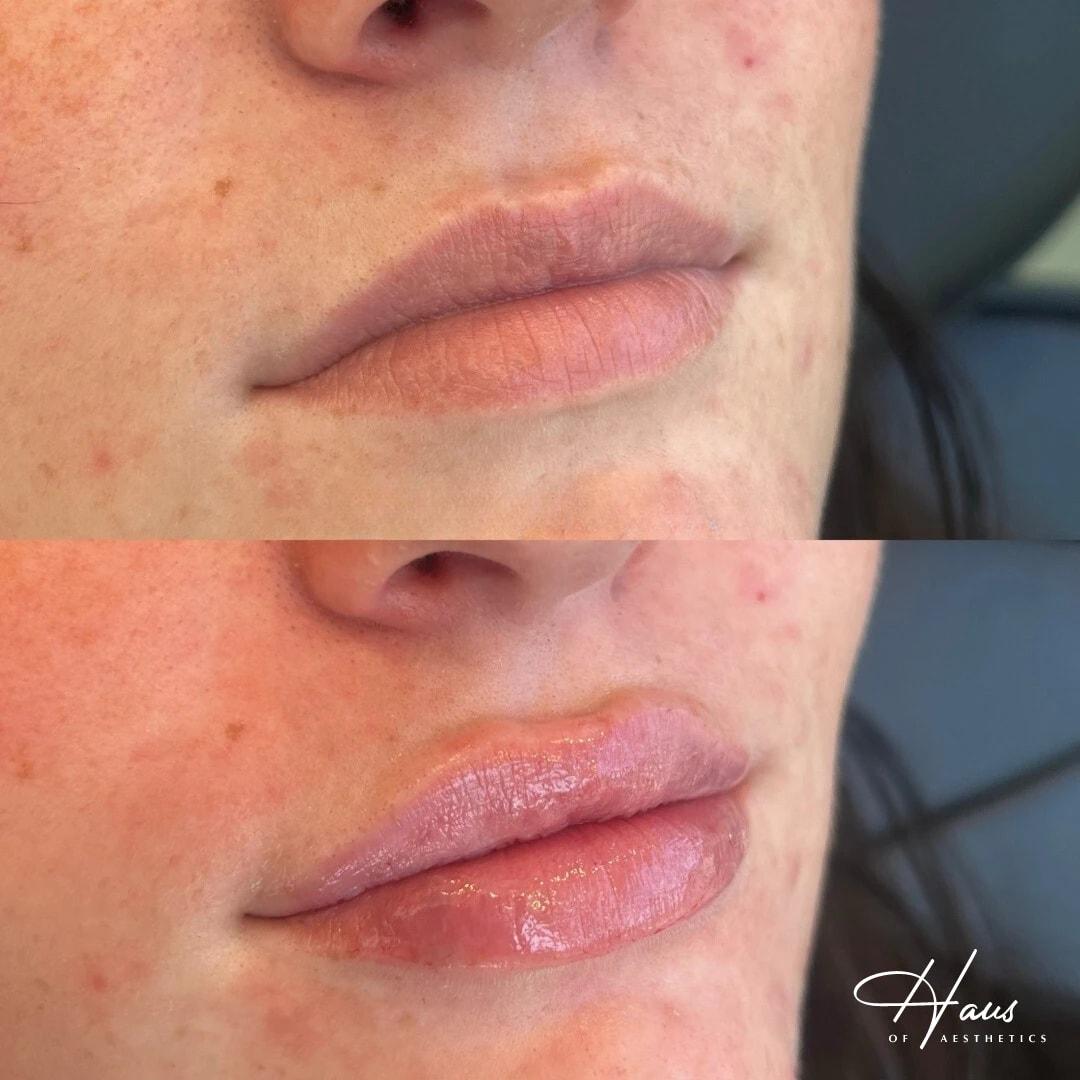 Haus of Aesthetics lip filler result — Salt Lake City, UT