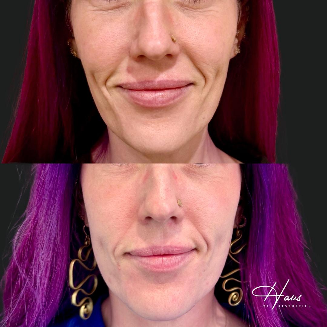 Haus of Aesthetics laser treatment result — Salt Lake City, UT