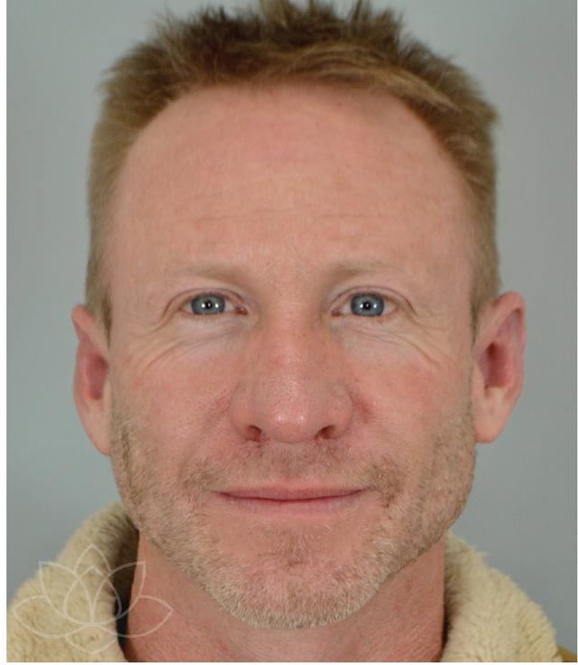 Functional Rhinoplasty after at Jordan L. Wallin, MD in St. George, UT