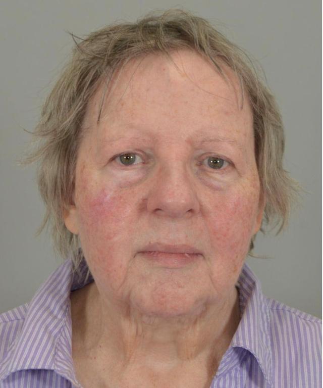Blepharoplasty before at Jordan L. Wallin, MD in St. George, UT