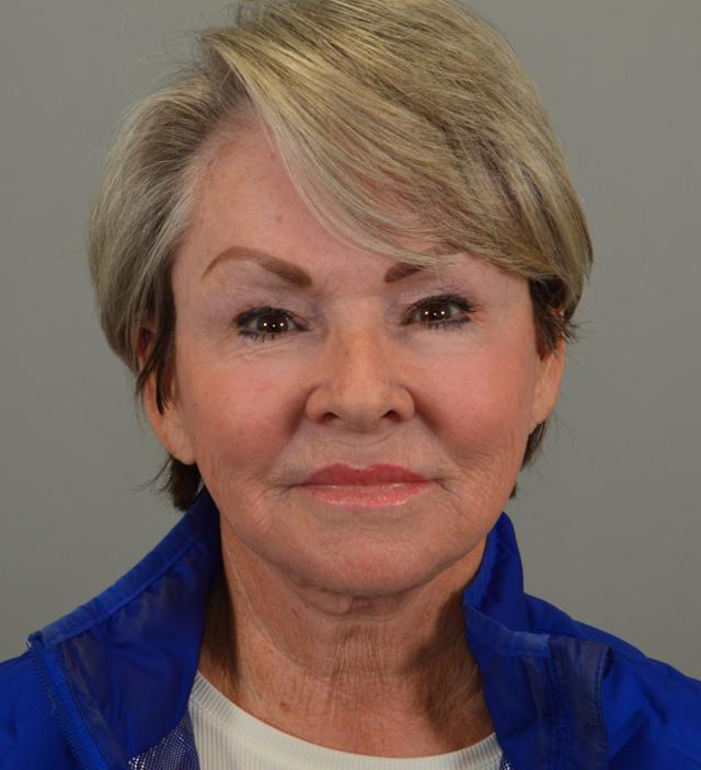 Facelift before at Jordan L. Wallin, MD in St. George, UT