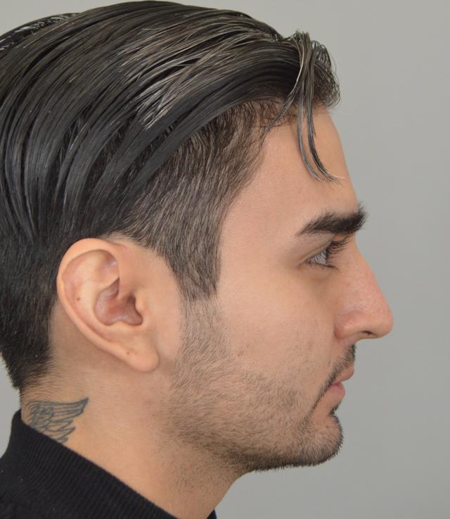 Functional Rhinoplasty before at Jordan L. Wallin, MD in St. George, UT
