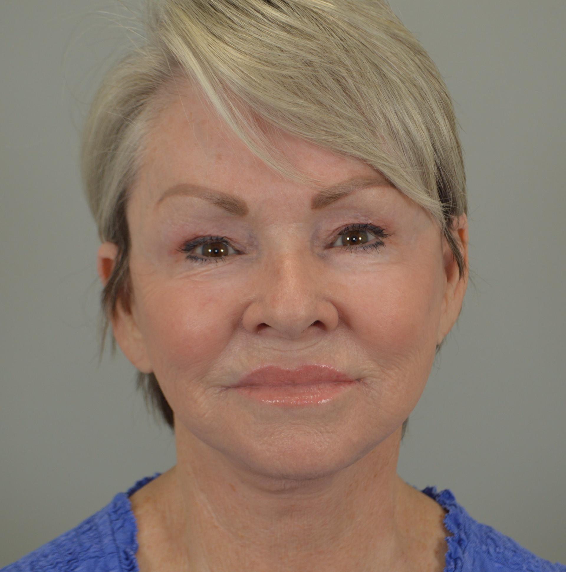 Jordan L. Wallin, MD facelift after — St. George, UT