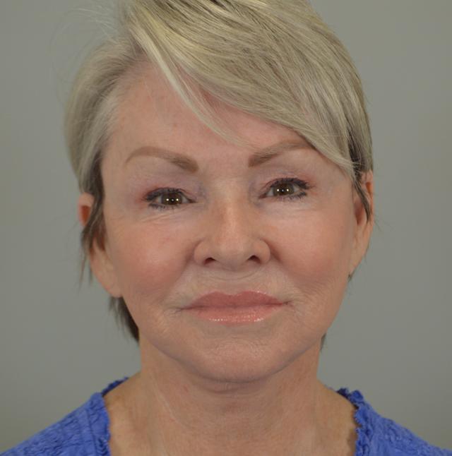 Facelift after at Jordan L. Wallin, MD in St. George, UT