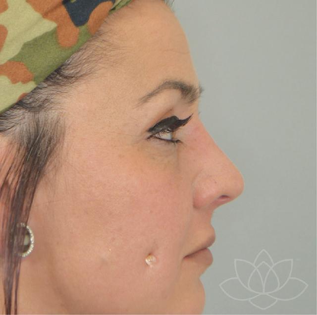 Functional Rhinoplasty after at Jordan L. Wallin, MD in St. George, UT