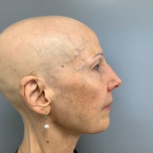 Functional Rhinoplasty before at Jordan L. Wallin, MD in St. George, UT