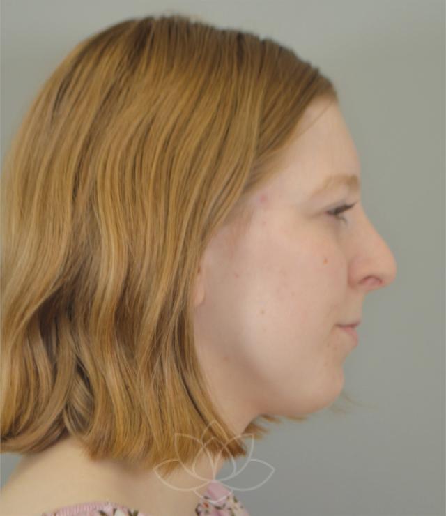 Functional Rhinoplasty before at Jordan L. Wallin, MD in St. George, UT