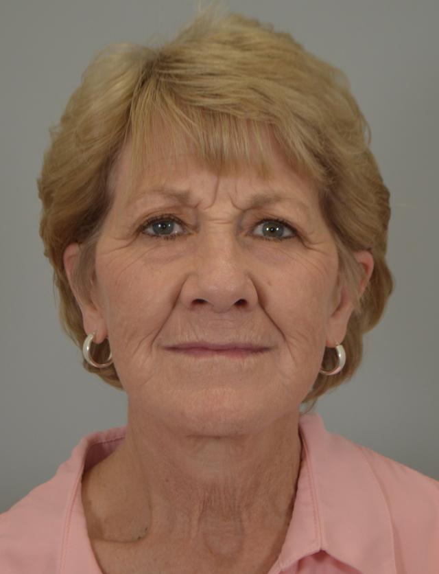 Facelift after at Jordan L. Wallin, MD in St. George, UT
