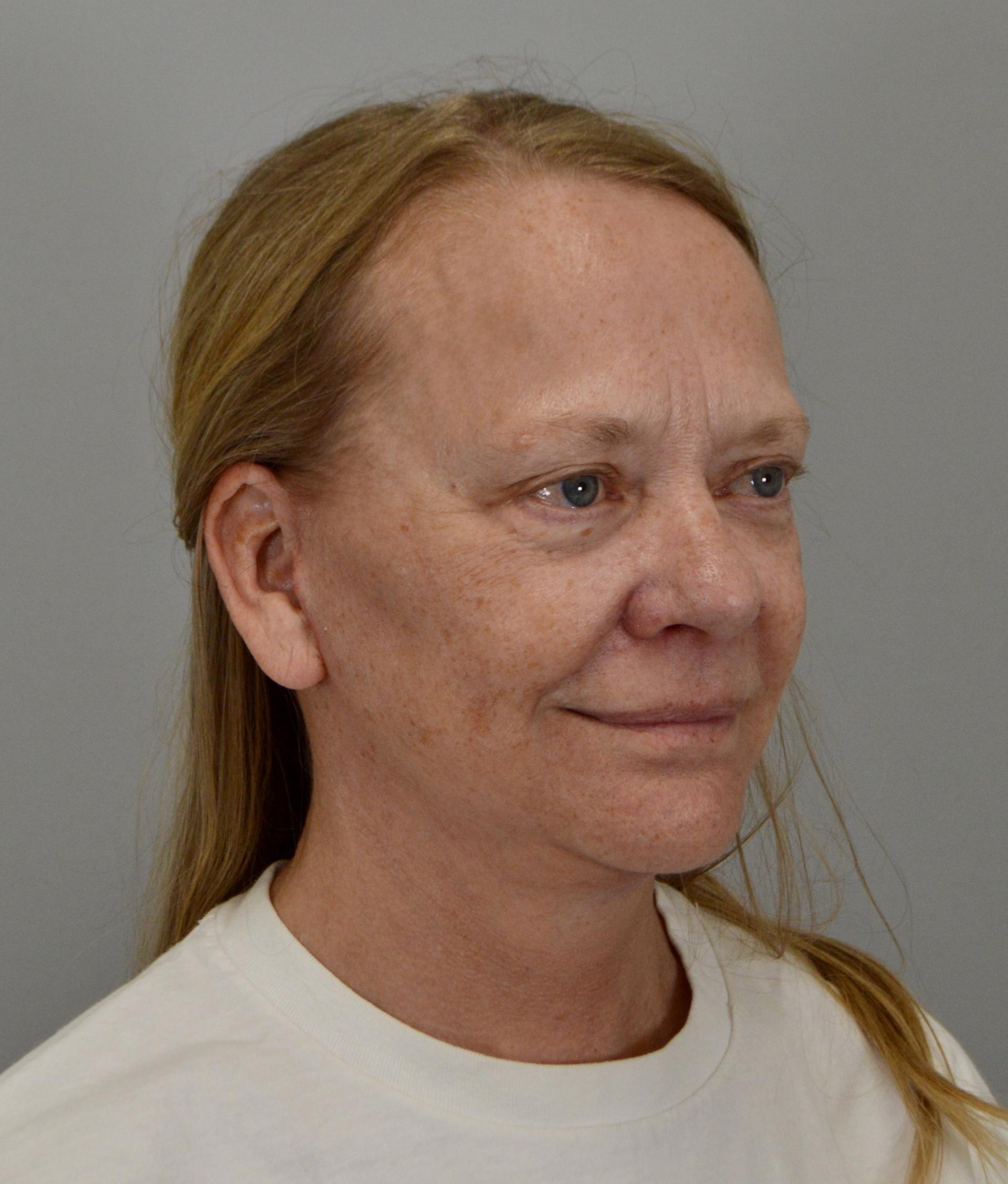 Jordan L. Wallin, MD facelift after — St. George, UT