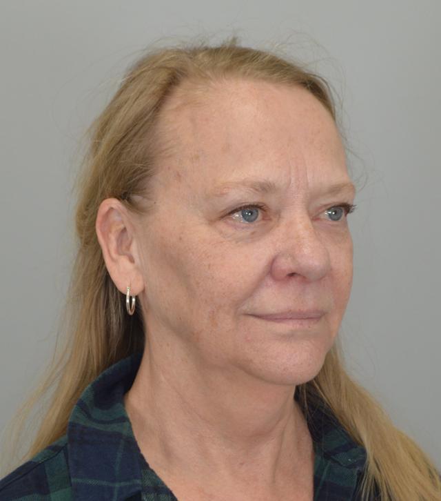 Neck Lift before at Jordan L. Wallin, MD in St. George, UT