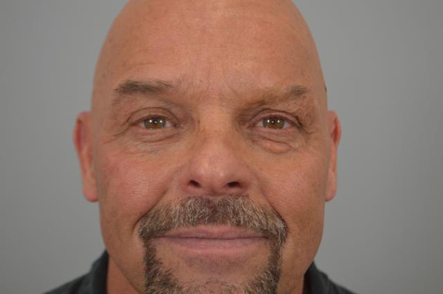 Blepharoplasty before at Jordan L. Wallin, MD in St. George, UT
