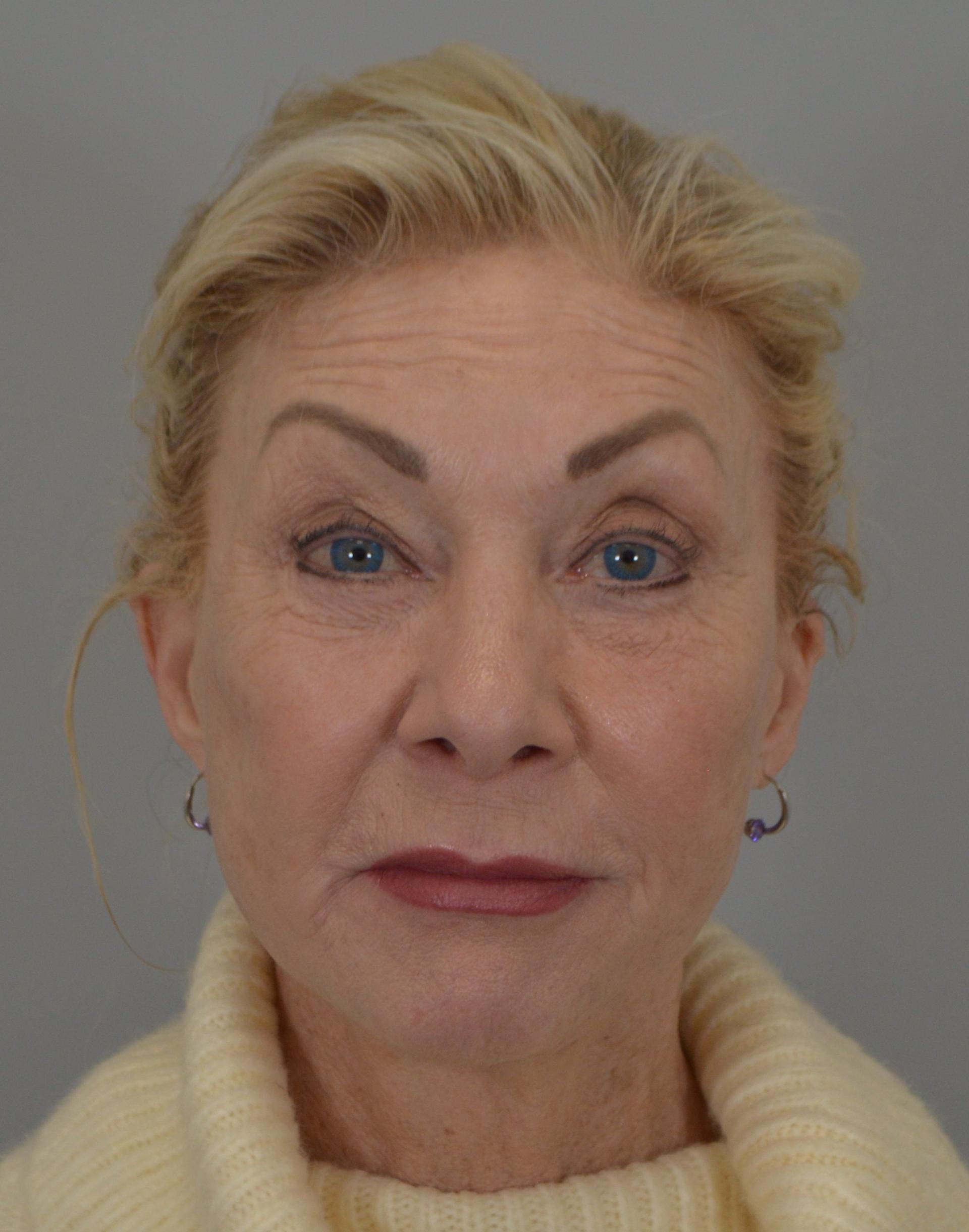 Jordan L. Wallin, MD facelift after — St. George, UT