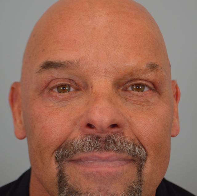 Blepharoplasty after at Jordan L. Wallin, MD in St. George, UT