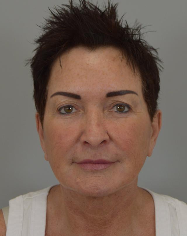 Facelift after at Jordan L. Wallin, MD in St. George, UT