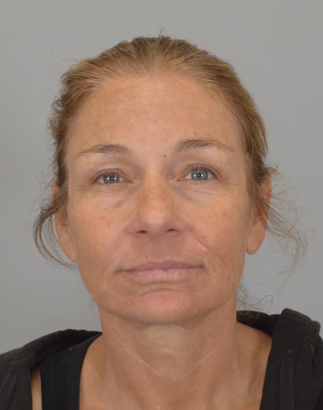 Facelift after at Jordan L. Wallin, MD in St. George, UT