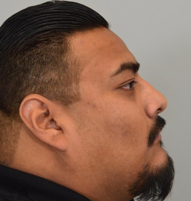 Functional Rhinoplasty before at Jordan L. Wallin, MD in St. George, UT